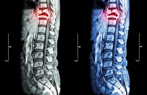  Spinal Cord Injury