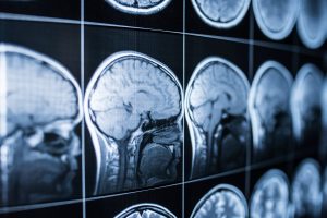 Sports-Related Brain Injuries